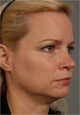 41 year old female with early jowls and neck laxity with excess volume ...