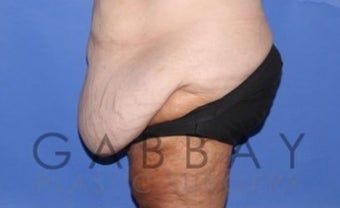 Panniculectomy Before & After Photos