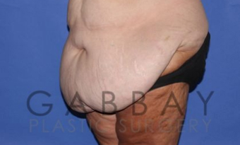Panniculectomy Before & After Photos