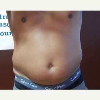 Ultraslim Fat Reduction Treatment Results Cost Realself