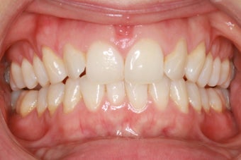 Braces Before & After Pictures - RealSelf