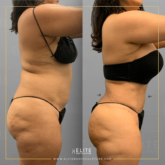 AirSculpt Before & After Pictures - RealSelf