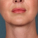 Kybella | Worth It? Reviews, Cost, Pictures - RealSelf