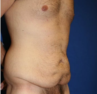 Patient #6031 Male Tummy Tuck (abdominoplasty) Before and After