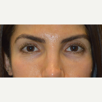 belotero before and after under eyes