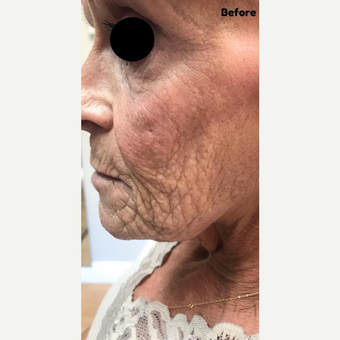 Morpheus8 Before After Pictures Realself