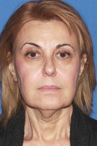 Smas Facelift What You Need To Know Realself