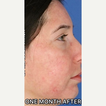 This Woman's Accutane Transformation Photos Went Viral — Before and After  Acne Photos