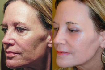 before and after image