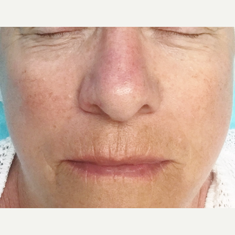 microneedling after before realself retinol