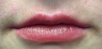 Juvederm Before & After Pictures - RealSelf