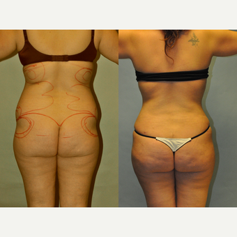 Patient 119942195  Brazilian Butt Lift (BBL) Before & After