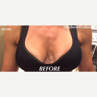 Vampire Breast Lift® Before & After Photos