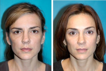 Midface Lift - Facial Rejuvenation photo from Thomas Romo, III, MD ...