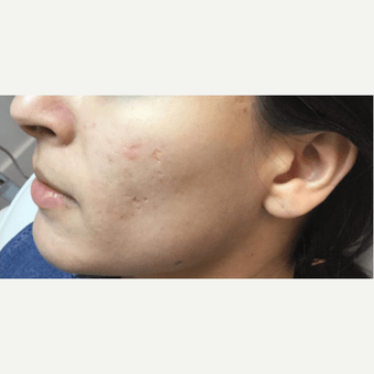 Microneedling Before & After Pictures - RealSelf