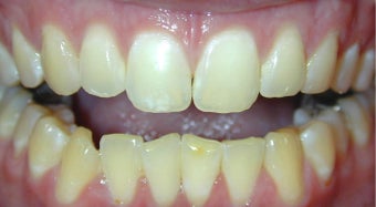 Adult TMJ and orthodontic treatment (case #1JW) before 224709