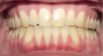 Adult TMJ and orthodontic treatment (case #1JW) after 224709
