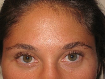Photographs of a 44‐year‐old woman who underwent eyebrow thread