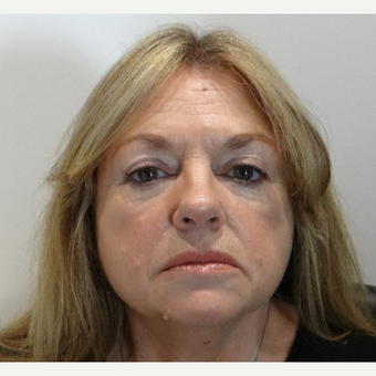 Teosyal Dermal Fillers Realself This product is also indicated for use with products in more than 80 countries, teoxane ranks among the top three manufacturers of. teosyal dermal fillers realself