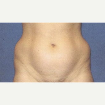39 F After Tummy Tuck with Lipo 360