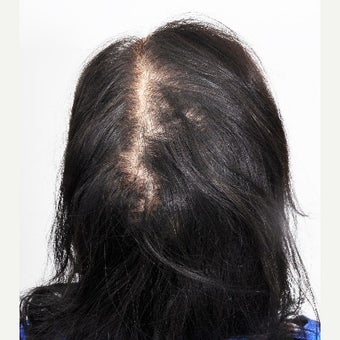 Prp For Hair Loss Worth It See Why 82 Say Yes Realself