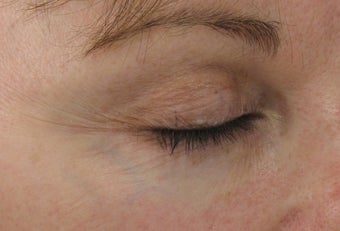 Fraxel Repair Skin Resurfacing Treatment Realself