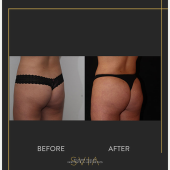 Patient 119942195, Brazilian Butt Lift (BBL) Before & After Photos