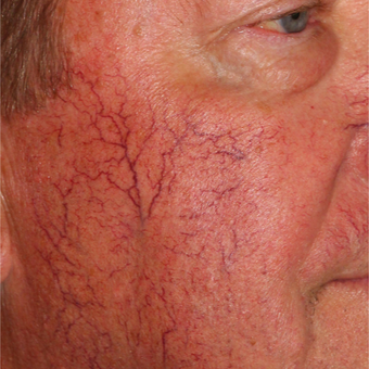 Rosacea Treatment Before & After Pictures - RealSelf