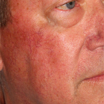 Rosacea Treatment Before & After Pictures - RealSelf