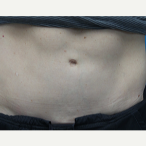 umbilical hernia repair and tummy tuck recovery time