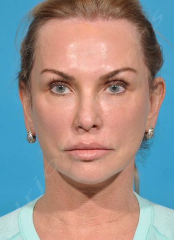 Biocorneum Advanced Scar Treatment Realself