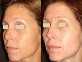 tretinoin before and after wrinkles