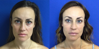 before and after image