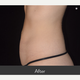 CoolSculpting® Elite Before & After Photos Patient 105, Boston, MA