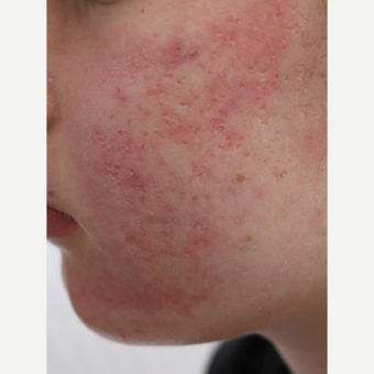 Acne Scars Treatment Before After Pictures Realself | acne scars treatment before after pictures realself Acne Scars Treatment Before After Pictures Realself | acne scars treatment before after pictures realself