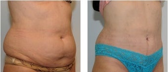 All About Smartlipo Laser Liposuction Realself