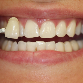zoom whitening near me zoom whitening near me