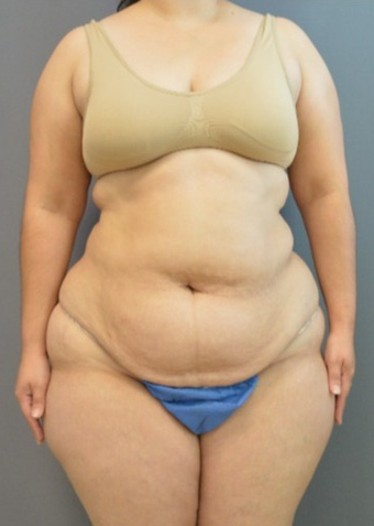 Laser Liposuction How It Works Recovery Results More