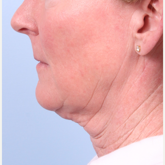 CO2 Laser Resurfacing Before & After Pictures