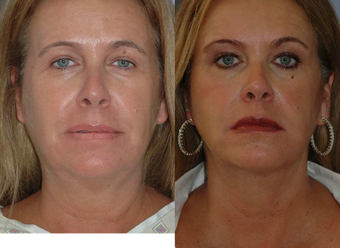before and after image