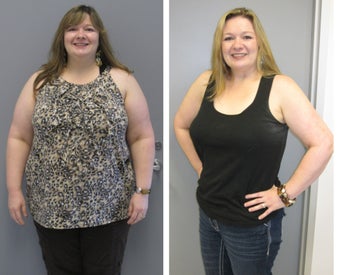 Sleeve Gastrectomy Before & After Pictures - RealSelf