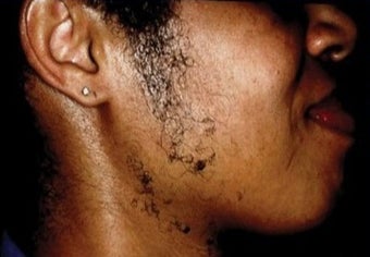 Laser Hair Removal Worth It See Why 98 Say Yes Realself