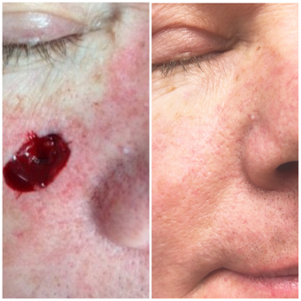 surgery mohs after before realself op years