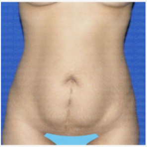 Best Tummy Tuck Before and After Photos Encino & Bakersfield