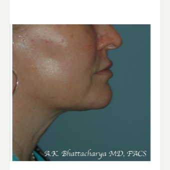 Kybella Before & After Pictures - RealSelf