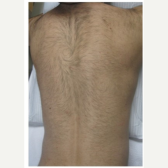 45+ Vag Laser Hair Removal Photos Gif