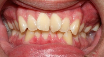 Teen Orthodontic Treatment  before 223626
