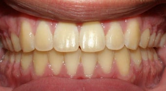Teen Orthodontic Treatment  after 223626