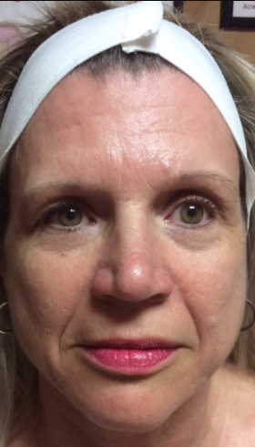 vampire facelift everything you want