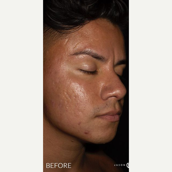 The Microneedling Rundown With Before and After Photos – Perfect Face  Aesthetic Medicine